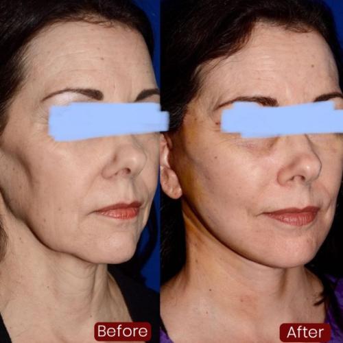 Mini facelift Before / After photo